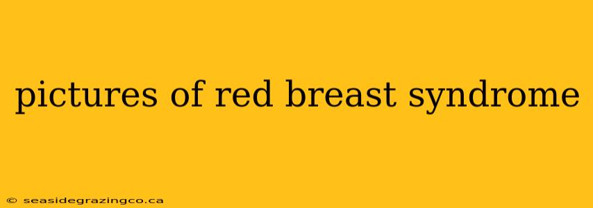pictures of red breast syndrome